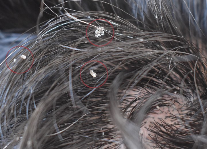 Cheveux pr&eacute;sentant des pellicules