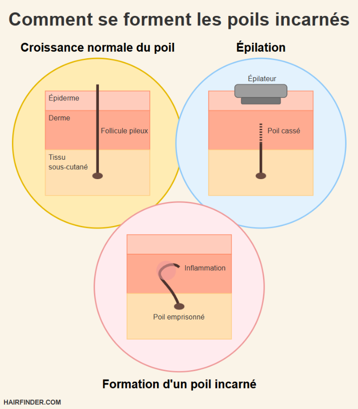 Infographie - Comment se forment les poils incarnés
